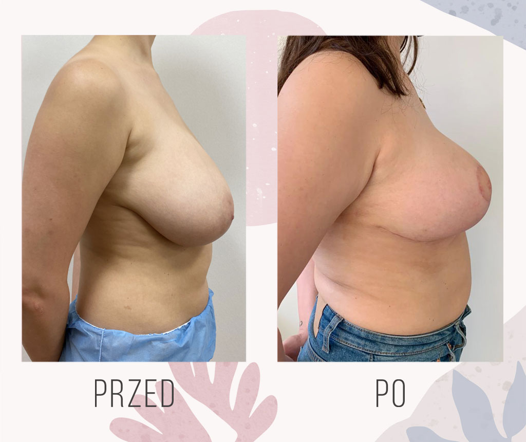Breast reduction - Cost, Before and After • OT.CO Poland