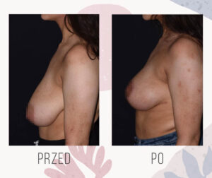 breast reduction 4