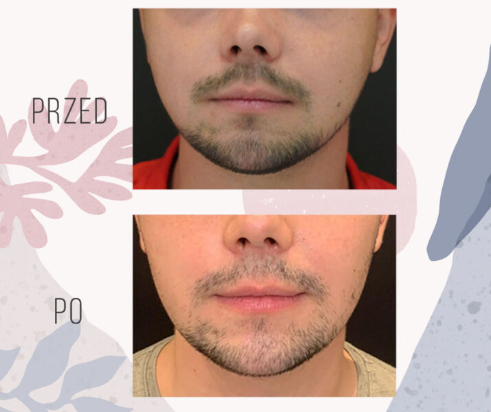 Buccal Fat Removal Cost, Before and After • OT.CO Poland