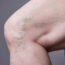 gluing varicose veins
