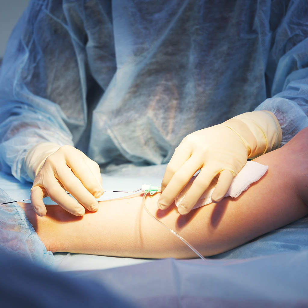 Varicose veins surgery