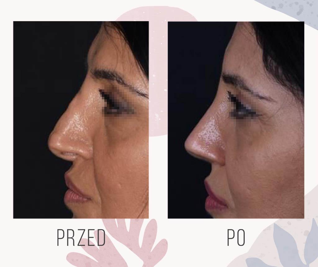 Visualization of rhinoplasty results before surgery; digital nose transformation comparison.