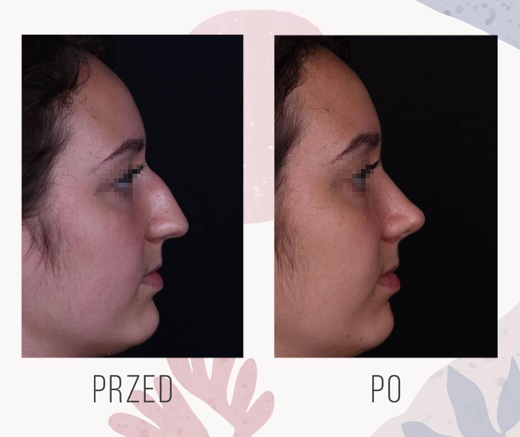 Visualization of rhinoplasty results before surgery with digital imaging software.