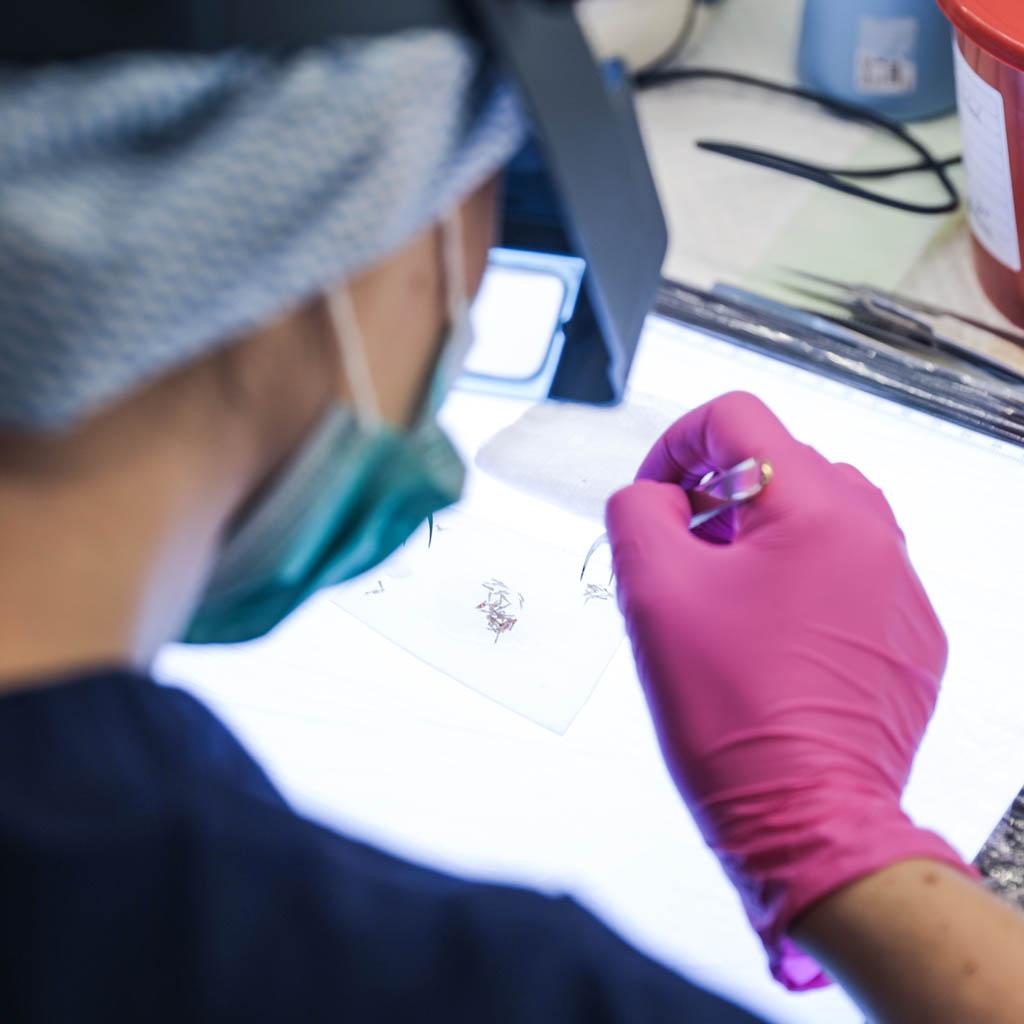 Follicular unit transplantation procedure showing hair transplant process in medical setting.