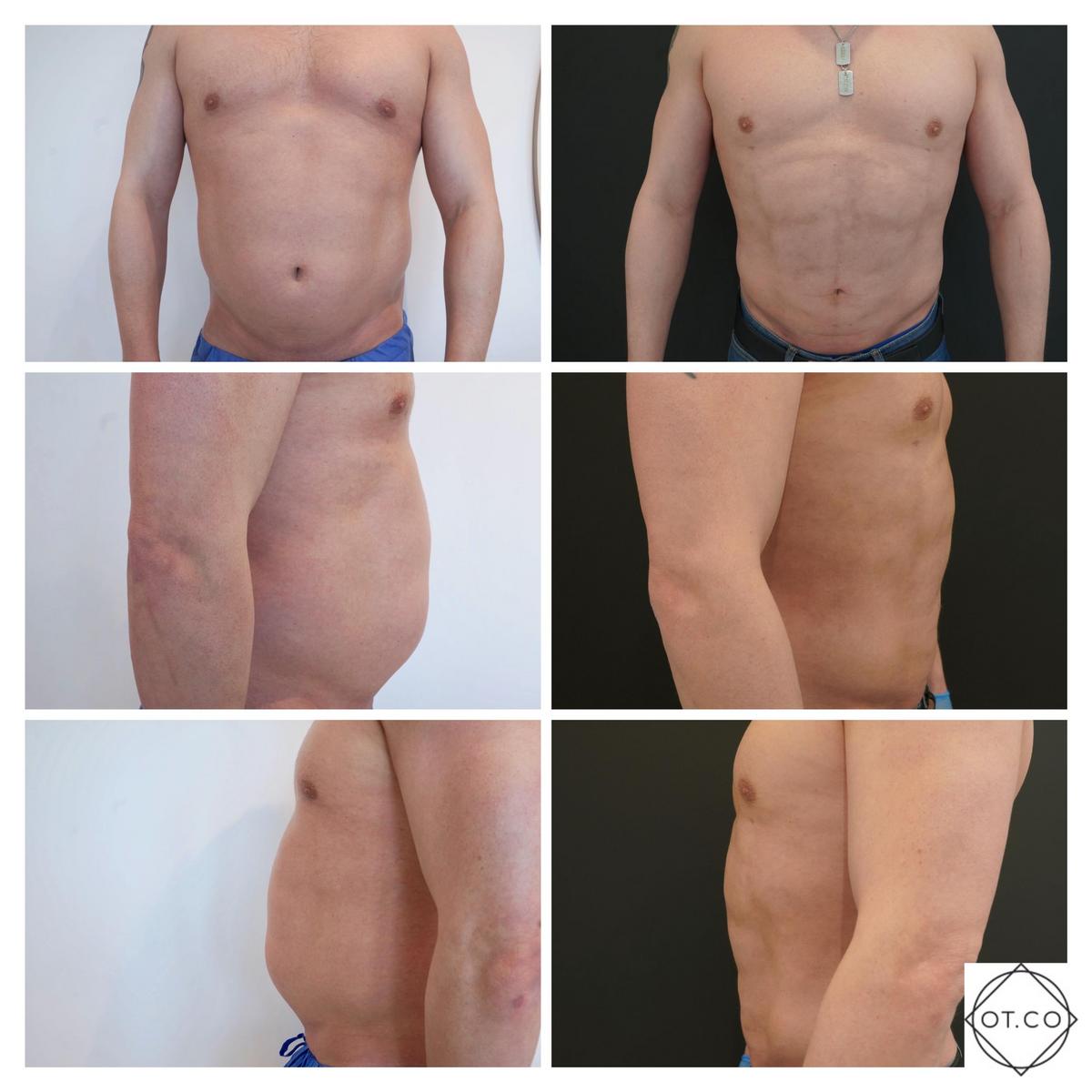 How much does abdominal liposuction cost and what are the financing options.