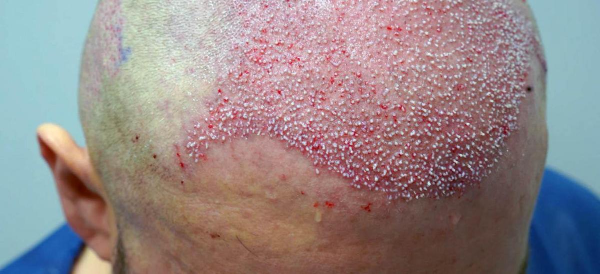 How Should You Prepare for a FUE Hair Transplant