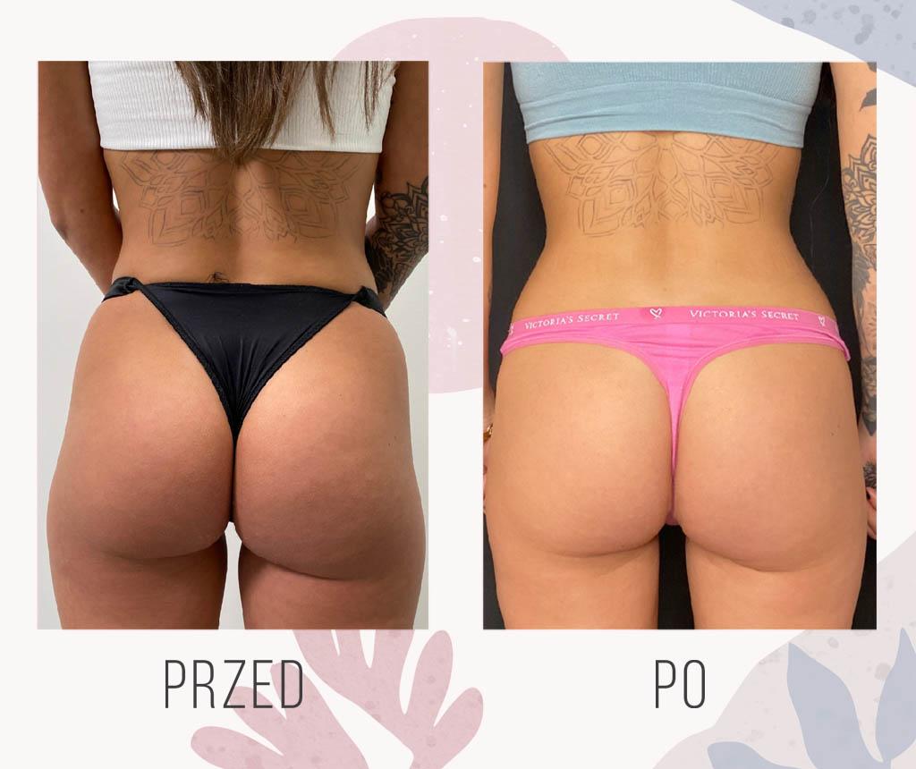 Alt text: Laser liposuction procedure suitability varies, consult with a professional.