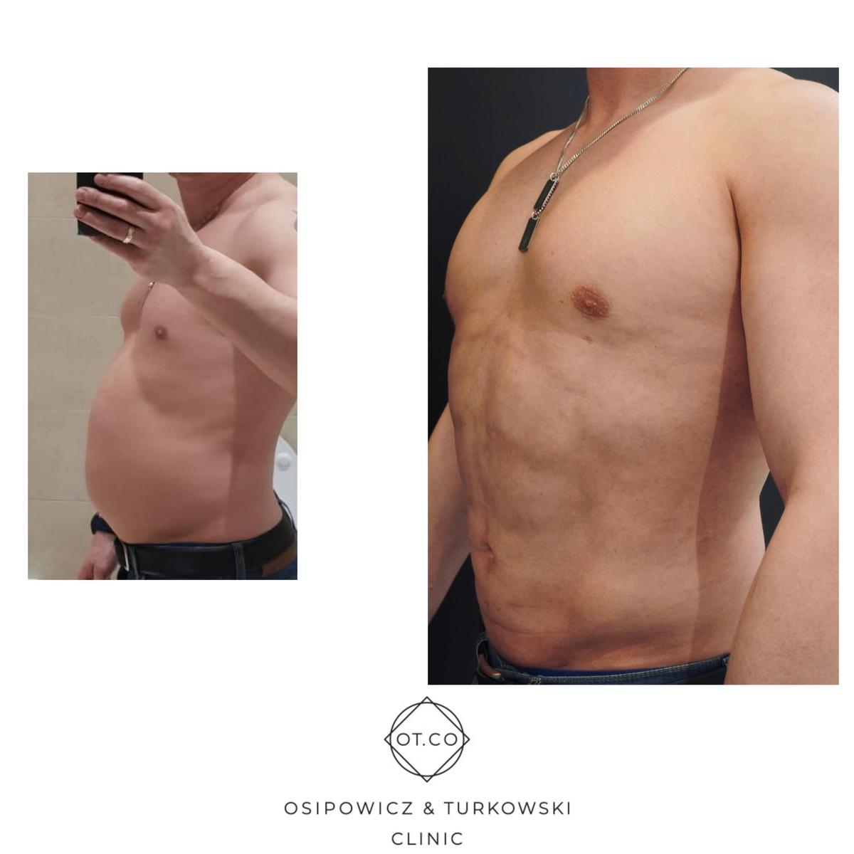 What abdominal liposuction methods are indicated for different cases