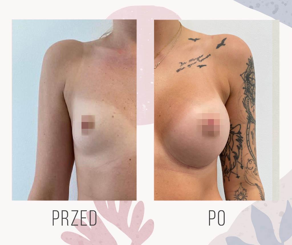Different types of breast implant procedures illustrated with medical diagrams.