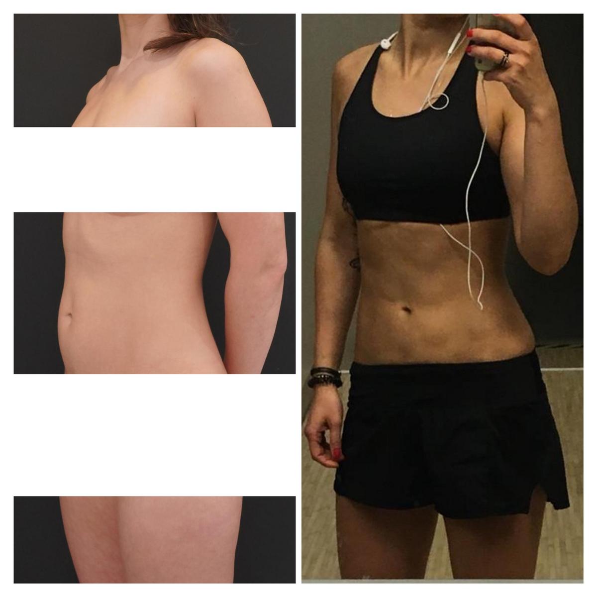 Long-term effects of liposuction and maintenance tips explained in an image.