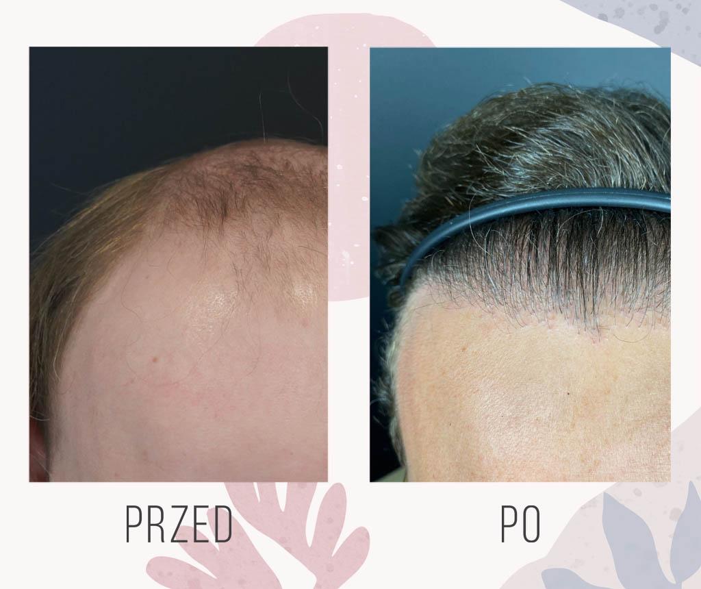 What Are the Long-Term Results and Benefits of FUE Hair Transplants