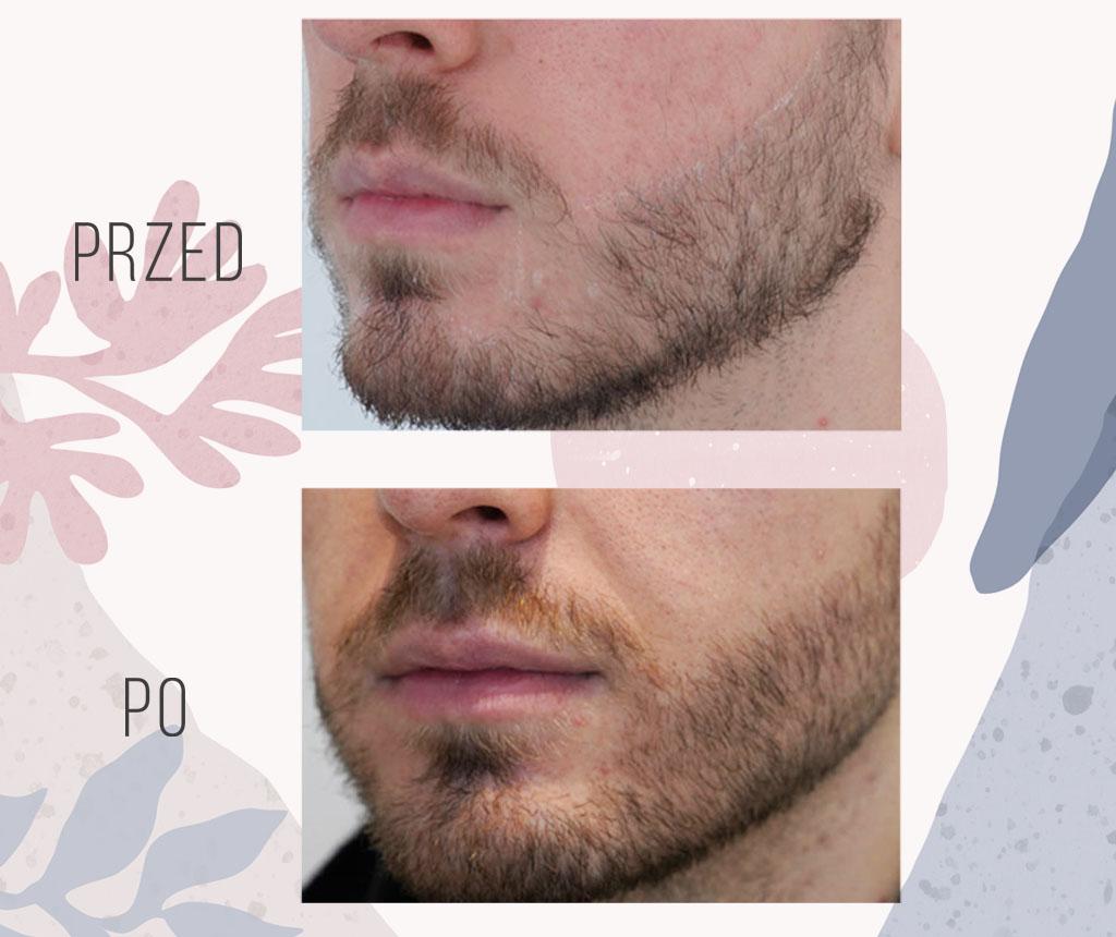 Factors influencing beard surgery costs: expertise, location, techniques, and extent of procedure.