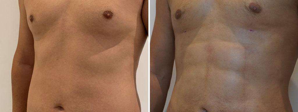 Difference between ultrasonic and classic liposuction techniques illustrated with visual comparison.