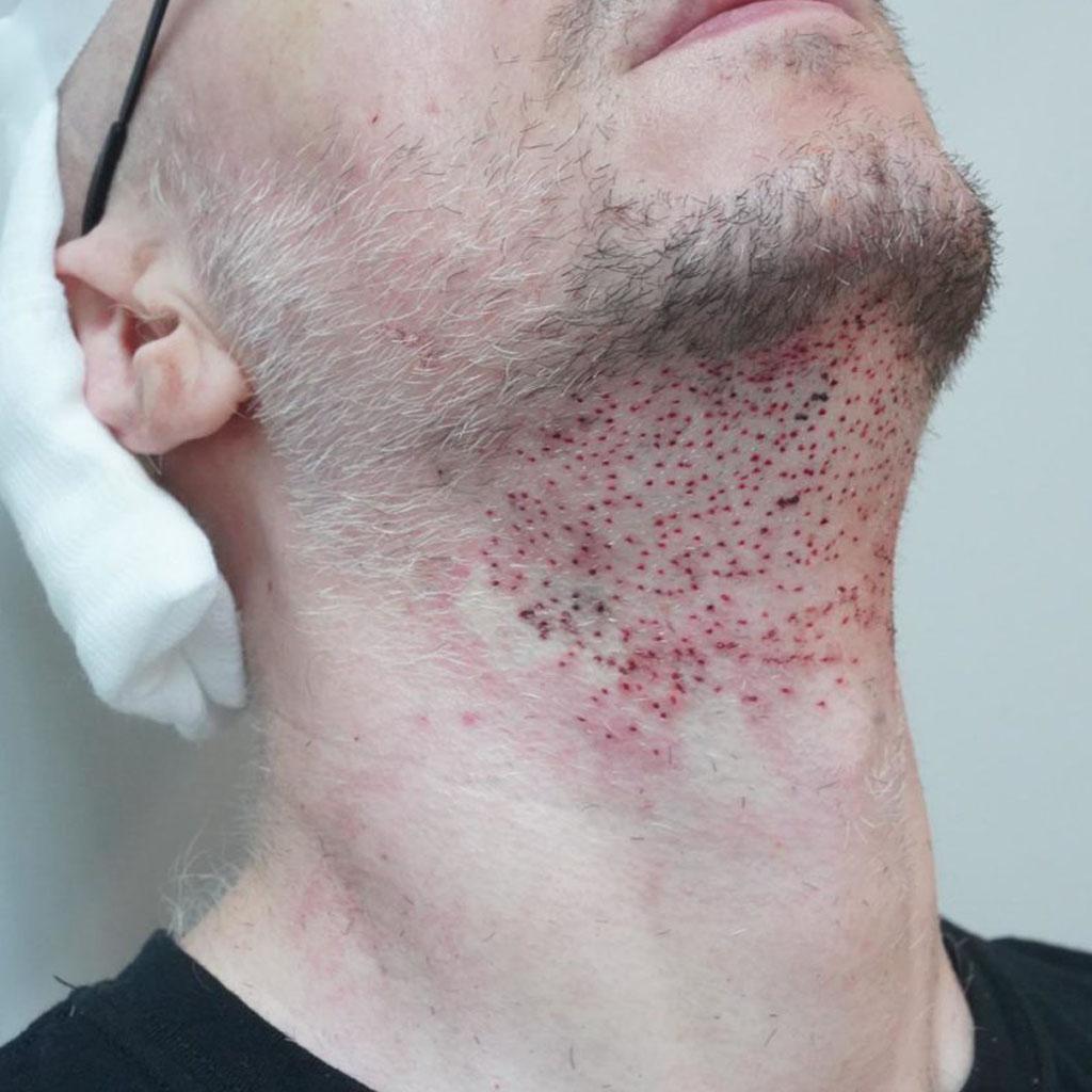 Alt text: Illustration of FUE beard restoration technique with labelled diagrams.