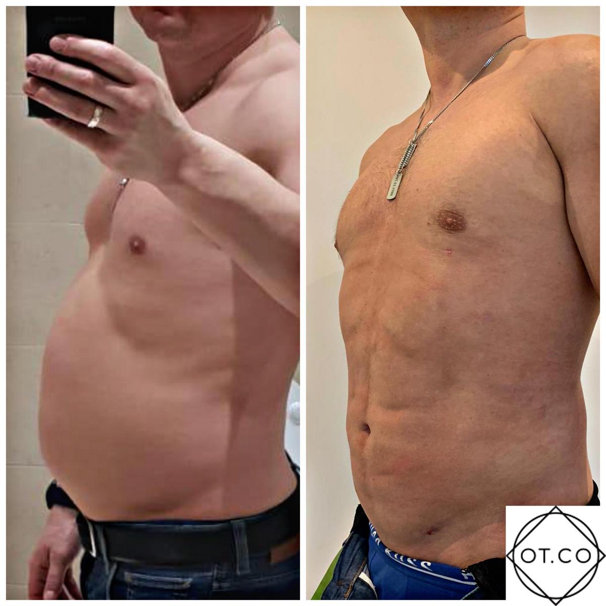 What is the recovery period after fat suction and what are the results of the procedure