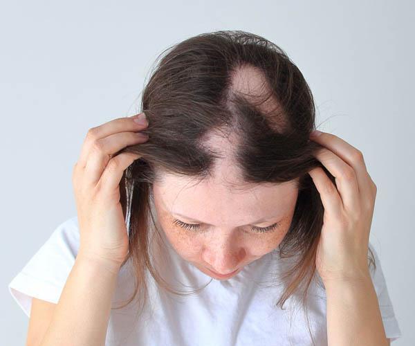 When Should Women Consider Visiting a Doctor for Hair Loss Issues