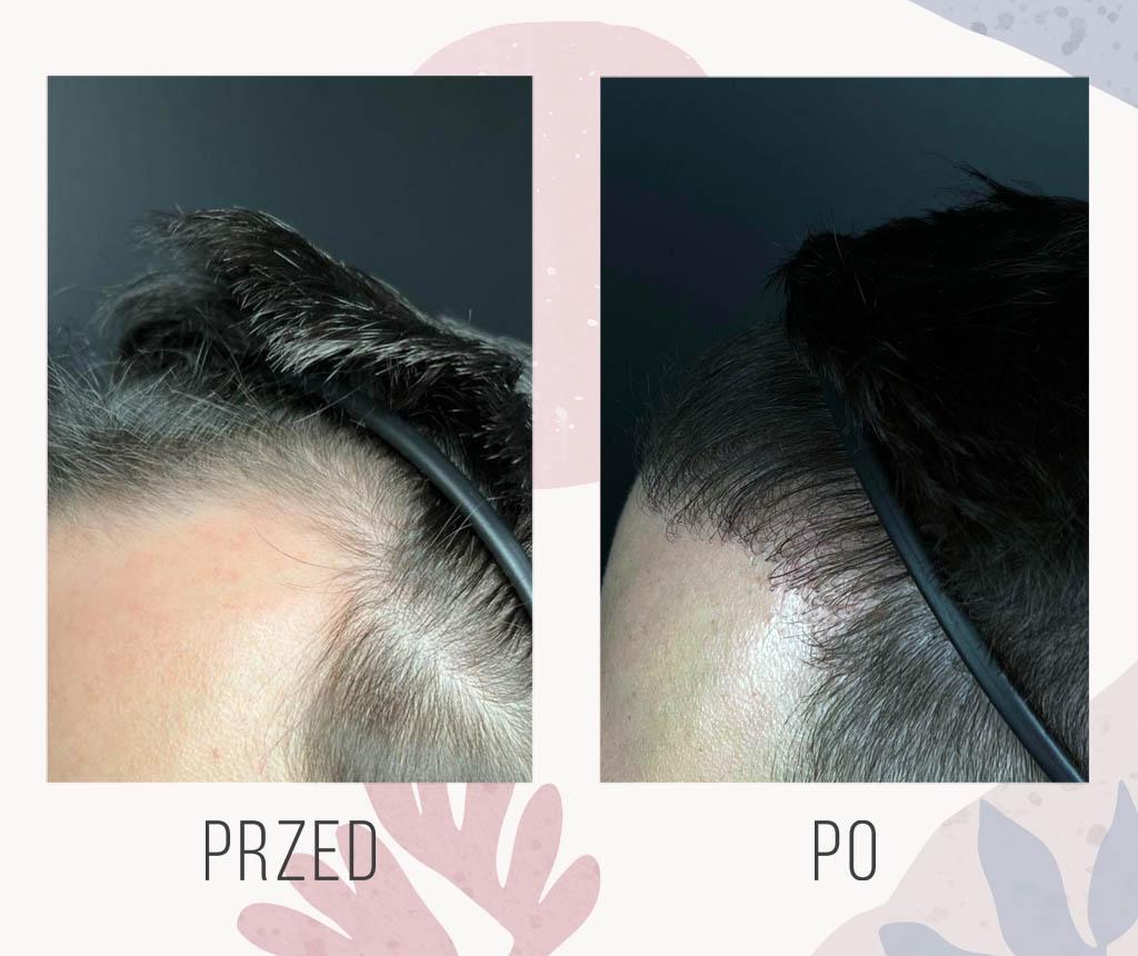 Alt text: Factors determining long-term success of hair transplants - an informative image.