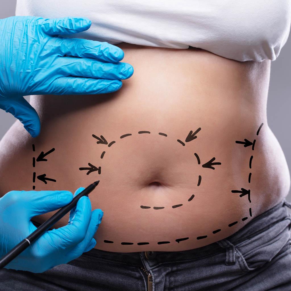 Plastic surgery procedures focus on body contouring.