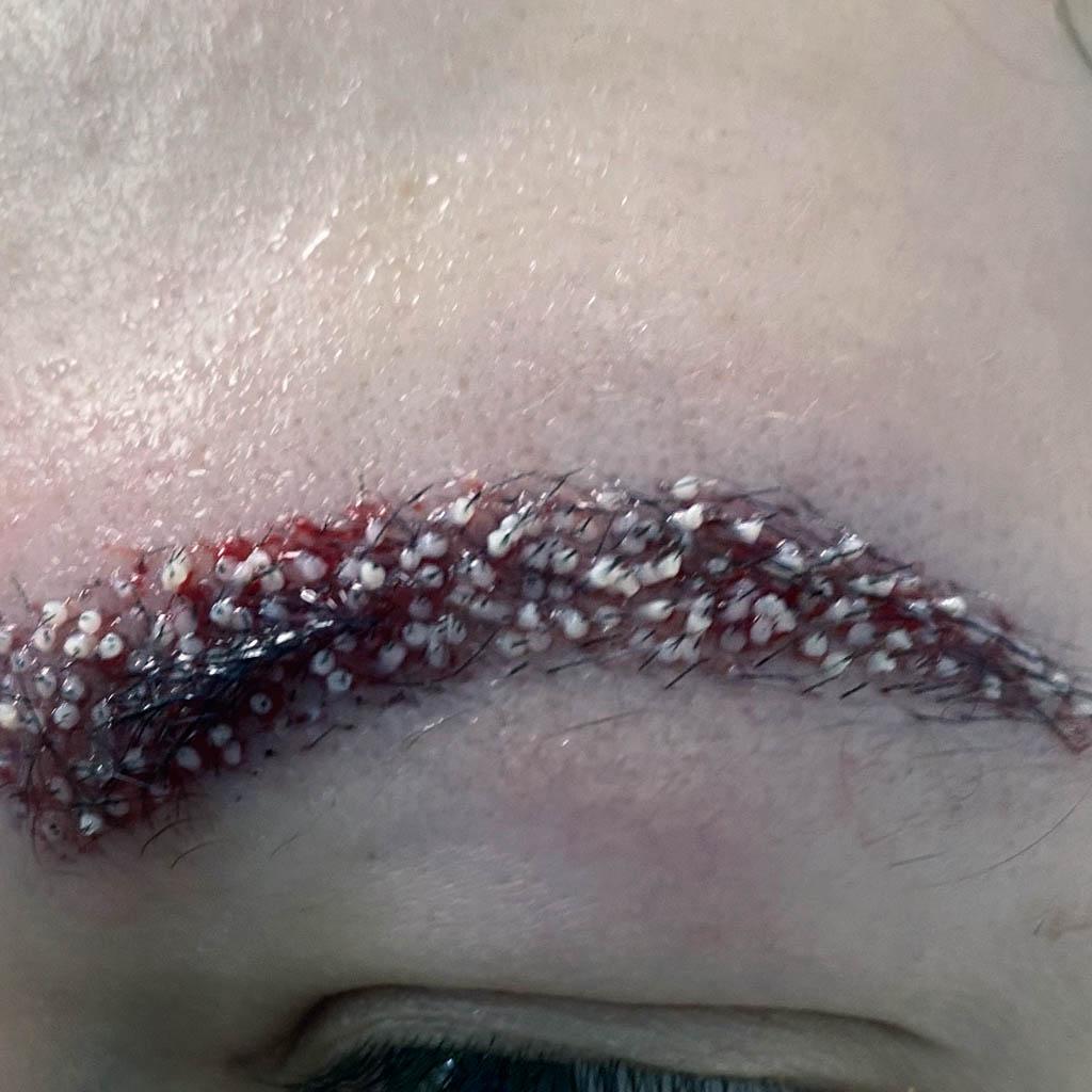 Why Are Hair Transplant Surgeries Becoming Popular in Poland, Especially for Women