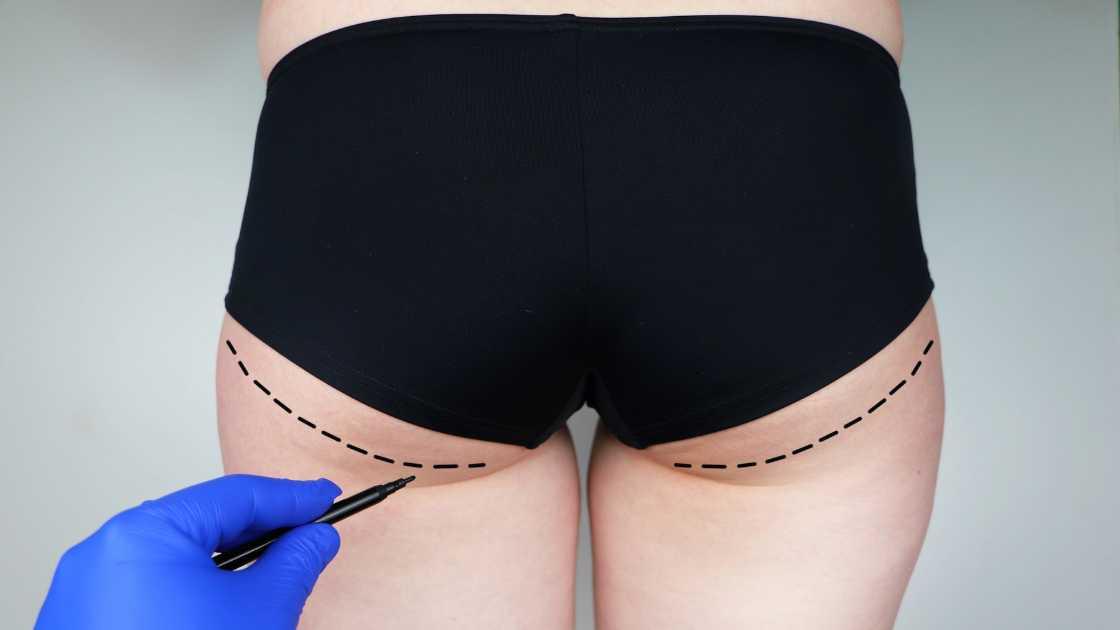 Surgical instruments laid out on a table for buttock augmentation preparation.
