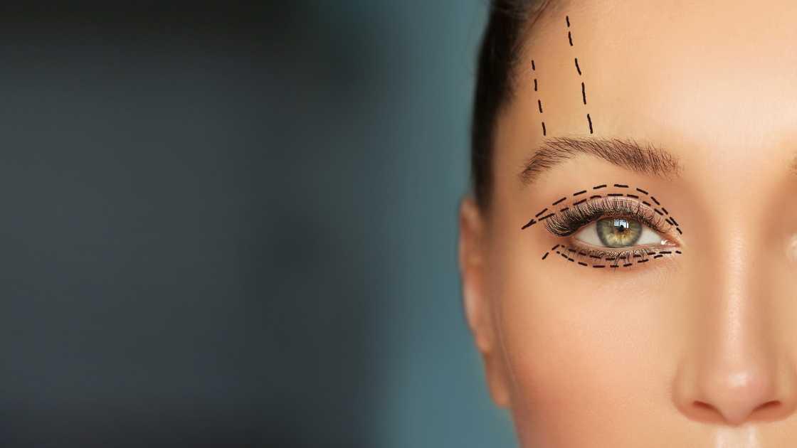 Mini facelift procedure steps: anesthesia, incisions, tissue repositioning, skin tightening, sutures.