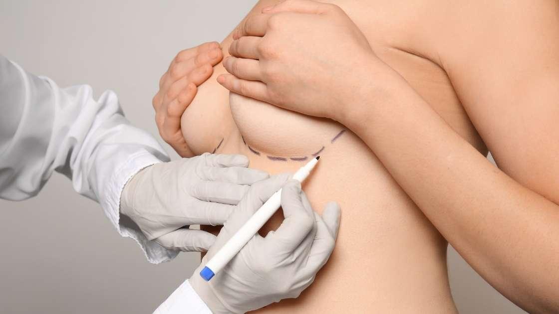 Permanent breast lipofilling results, before and after comparison.
