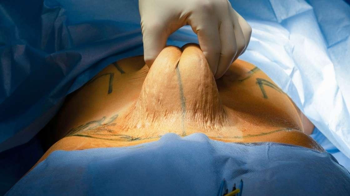 A person recovering after abdominoplasty, resting in bed with a pillow.