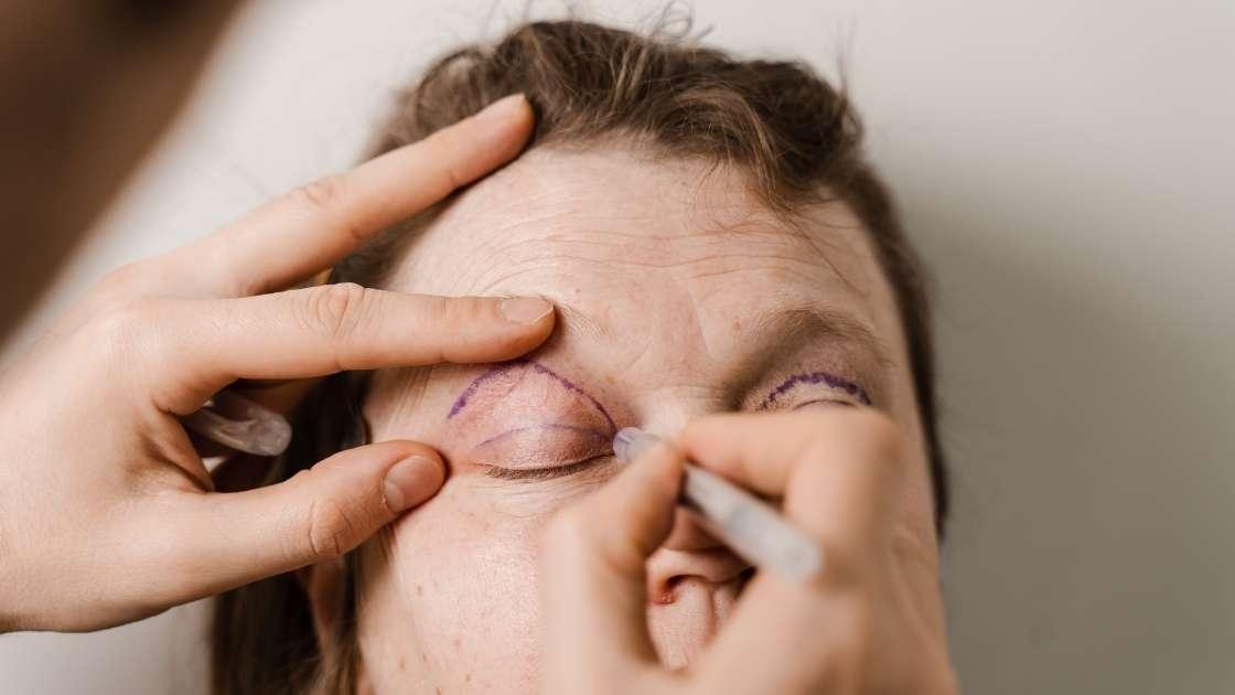 Upper eyelid plastic surgery stages: anesthesia, incision, fat removal, tissue tightening, sutures.