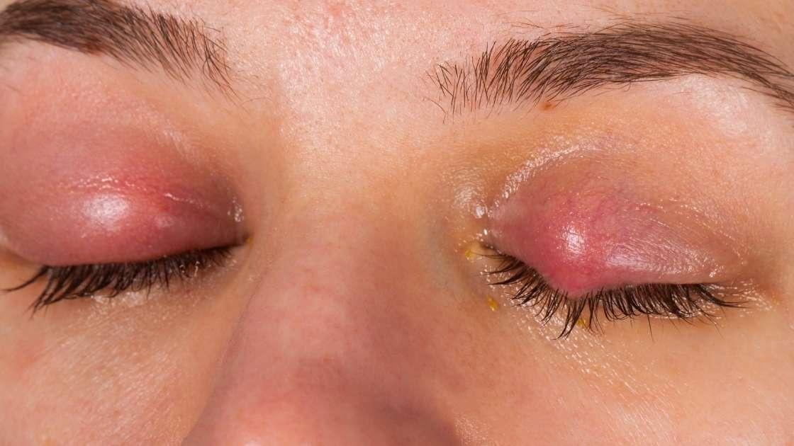 What is an upper eyelid hernia and how to treat it? • OT.CO Clinic