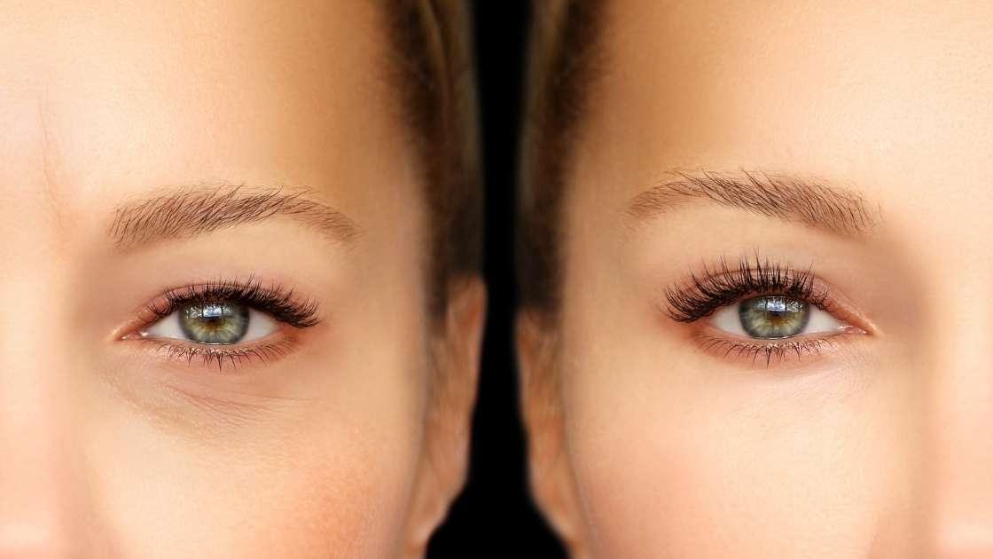 A close-up photo of someone's eyes before undergoing blepharoplasty surgery.