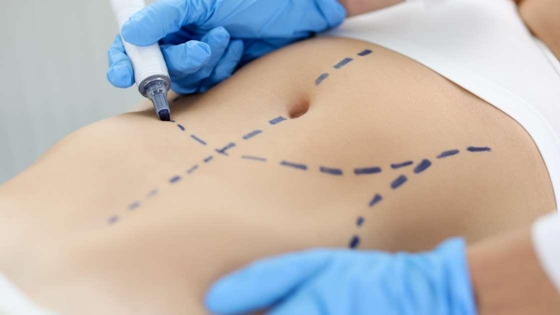 Abdominoplasty price comparison chart showing impact of clinic location on costs.
