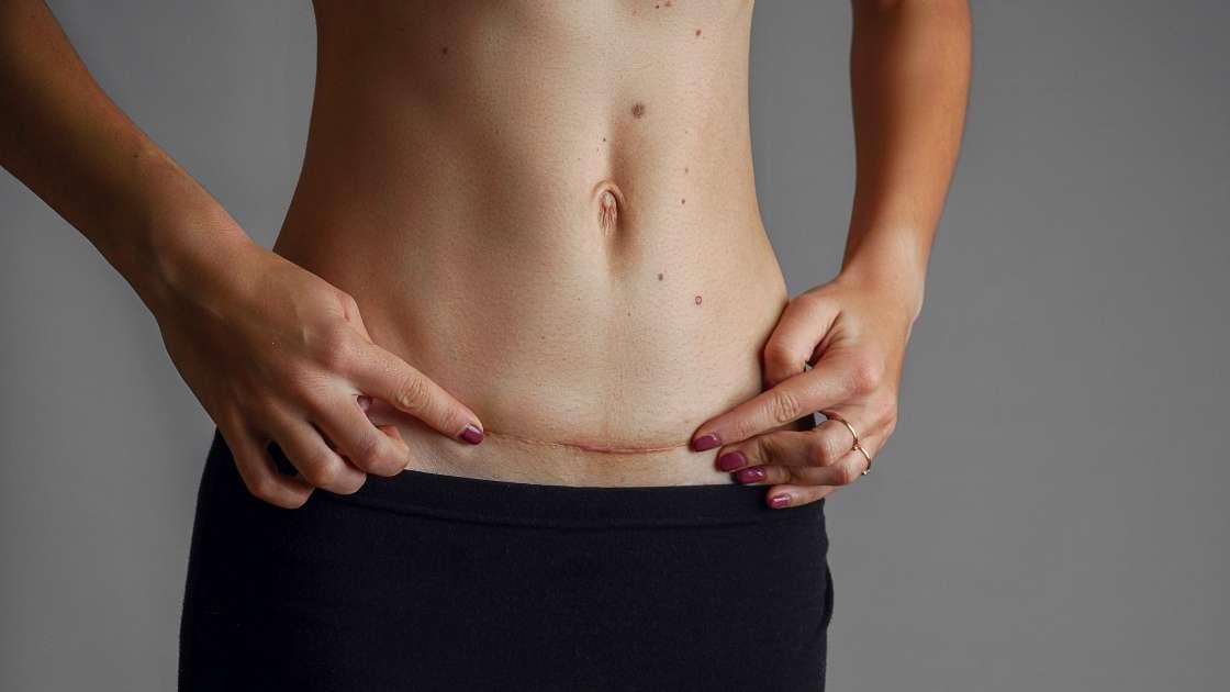 How to care for an abdominoplasty scar for best results.