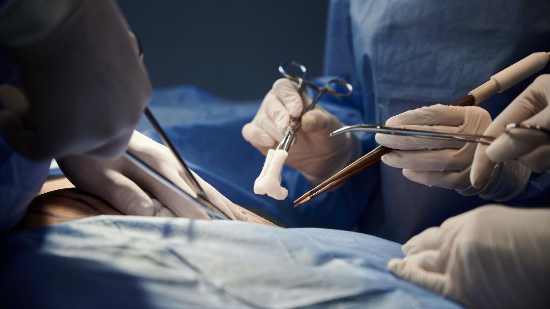 Medical equipment used in abdominal plastic surgery, with price tag and calculator.