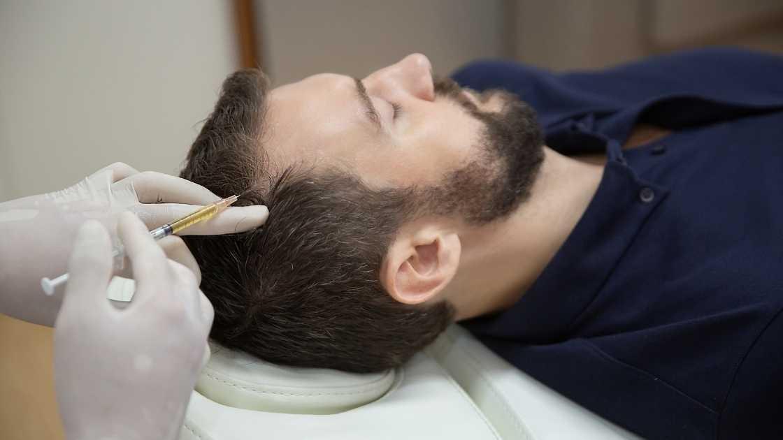 Hair mesotherapy treatment process showing injections being administered on the scalp.