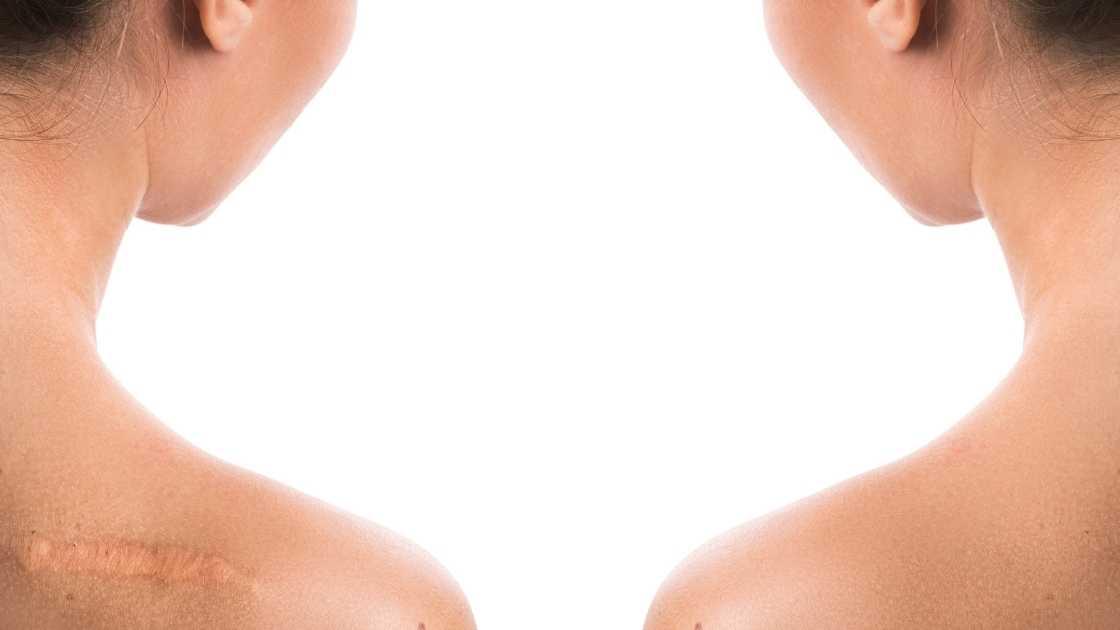 Types of scars that laser removal can target.