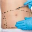 miniabdominoplastyka