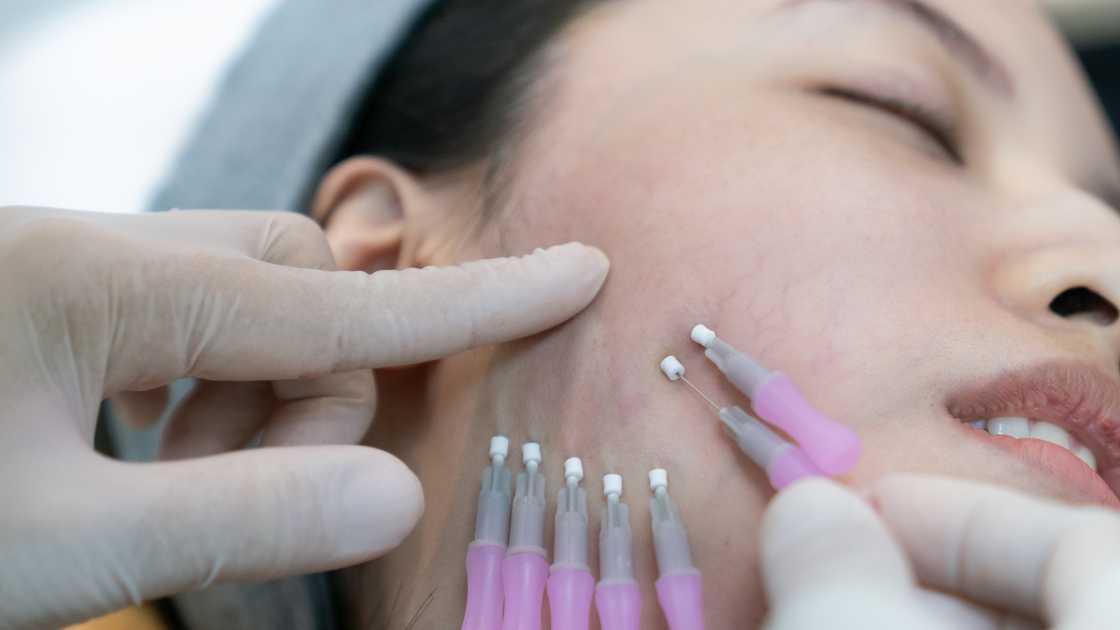 Types of lifting threads for cosmetic procedures, labeled and displayed clearly.