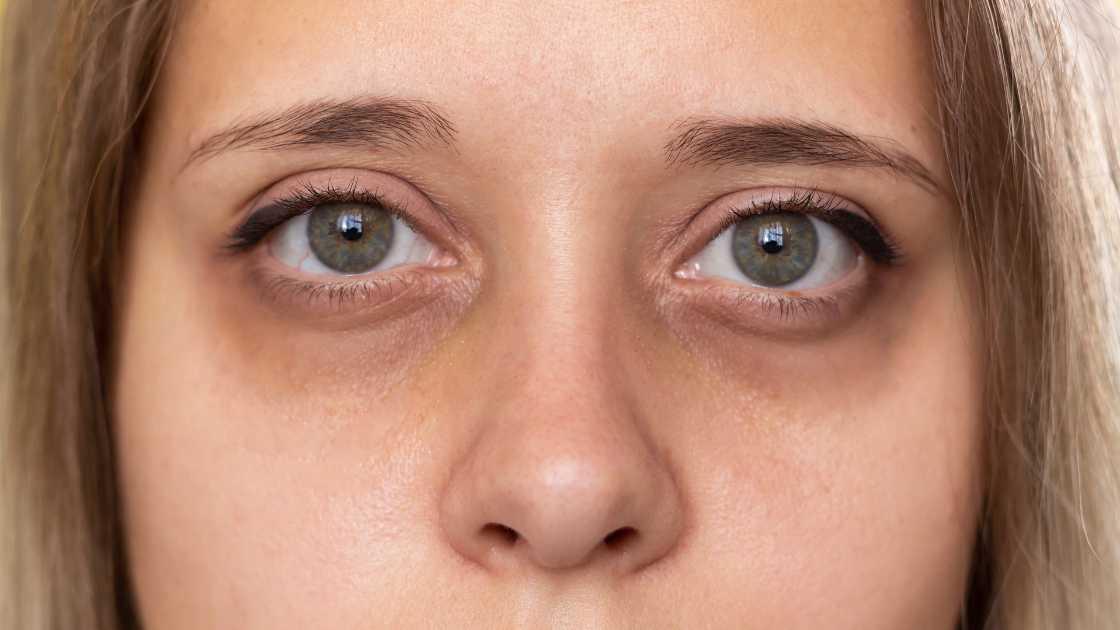 Types of substances used to fill the tear valley in a medical diagram.