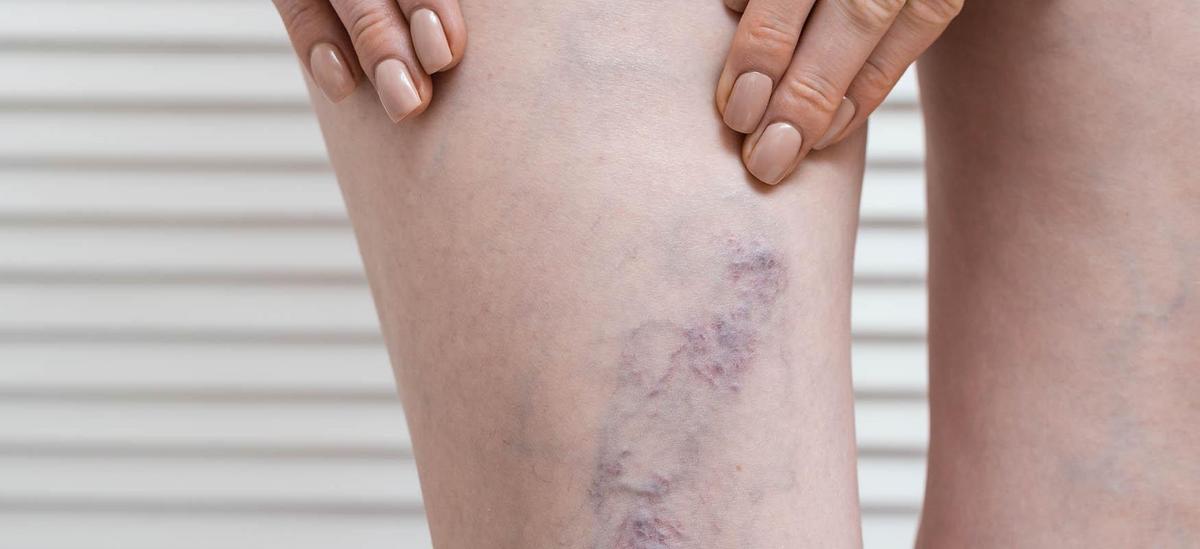 Home Remedies for Varicose Veins During Pregnancy